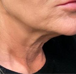 Sofwave Before & After Patient #1602